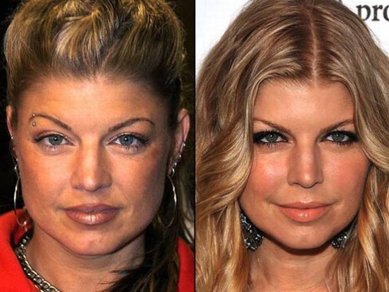 Celebrities πριν και μετά την πλαστική...  [ΦΩΤΟ] - Φωτογραφία 5