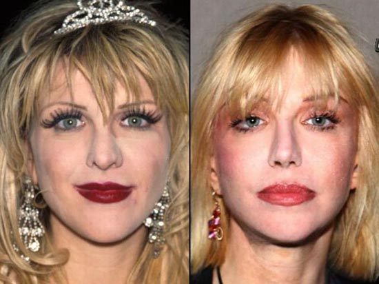 Celebrities πριν και μετά την πλαστική...  [ΦΩΤΟ] - Φωτογραφία 6
