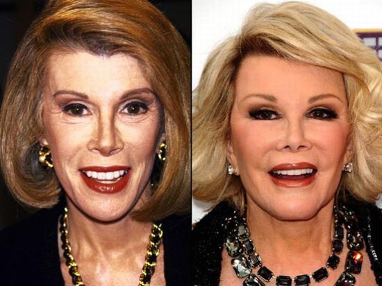 Celebrities πριν και μετά την πλαστική...  [ΦΩΤΟ] - Φωτογραφία 8