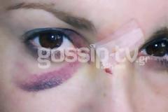 Με μαυρισμένο μάτι πασίγνωστη Ελληνίδα ηθοποιός. Τι της συνέβη;