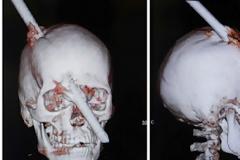 Διαπέρασε το κρανίο του ράβδος και... δεν έπαθε τίποτα!