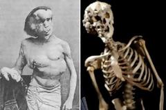 O “Άνθρωπος Ελέφαντας”: Μυστήριο παραμένει η τρομερή παραμόρφωση του [φωτο]