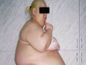 ΣΟΚΑΡΙΣΤΙΚΗ ΦΩΤΟ: Αφαίρεσαν λίπος 57 κιλών από την κοιλιά μιας Ρωσίδας - Φωτογραφία 1