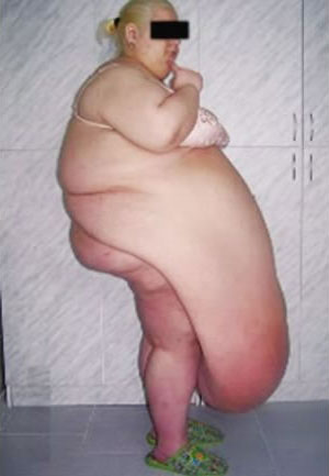 ΣΟΚΑΡΙΣΤΙΚΗ ΦΩΤΟ: Αφαίρεσαν λίπος 57 κιλών από την κοιλιά μιας Ρωσίδας - Φωτογραφία 2