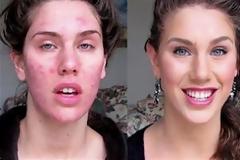 Νίκησε την ακμή κι ανέκτησε την αυτοπεποίθησή της