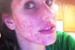 Το πιο διάσημο κορίτσι με ακμή έγινε μοντέλο!