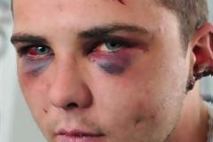 Εικοσάχρονος έπεσε θύμα άγριας επίθεσης - Του έκοψαν κομμάτι από το αυτί με δαγκωματιά!