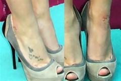 ΔΕΙΤΕ: Η ψωρίαση δεν κάνει διακρίσεις!