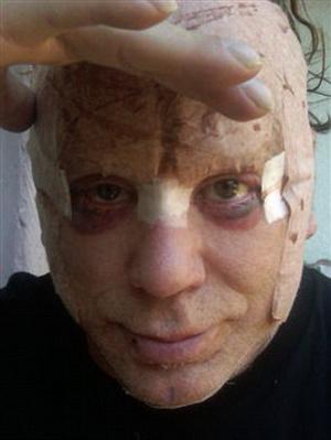 Σοκαριστικό! Διάσημος ηθοποιός αναρρώνει από το lifting στο πρόσωπο και δείχνει τις φωτογραφίες - Φωτογραφία 2