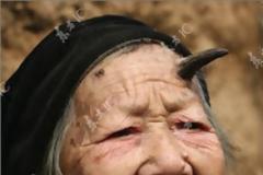 ΔΕΙΤΕ: Άνθρωποι με αληθινά κέρατα….
