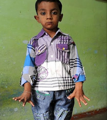 Ο μικρός Arpan γεννήθηκε με 25 δάχτυλα! - Φωτογραφία 2