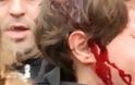 Σοκ στην Ισπανία από τον τραυματισμό 13χρονου διαδηλωτή από αστυνομικούς.. Βίντεο.