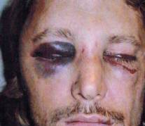 ΣΟΚ: Τον «έσπασε στο ξύλο» ο Olivier Martinez τον πρώην της Halle Berry ( pics ) - Φωτογραφία 1