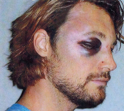 Σοκαριστικές φωτό: Τον «έσπασε στο ξύλο» ο Olivier Martinez τον πρώην της Halle Berry - Φωτογραφία 3