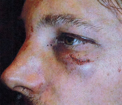 Σοκαριστικές φωτό: Τον «έσπασε στο ξύλο» ο Olivier Martinez τον πρώην της Halle Berry - Φωτογραφία 5
