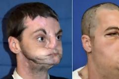 ΑΠΙΣΤΕΥΤΟ: Απέκτησε πρόσωπο μετά από 15 φρικτά χρόνια με μάσκα!