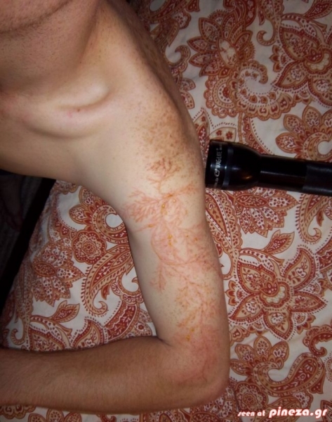 Δείτε ανθρώπινο δέρμα που χτυπήθηκε από κεραυνό (pics) - Φωτογραφία 3
