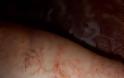 Δείτε ανθρώπινο δέρμα που χτυπήθηκε από κεραυνό (pics)