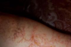 Δείτε ανθρώπινο δέρμα που χτυπήθηκε από κεραυνό (pics)