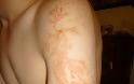 Δείτε ανθρώπινο δέρμα που χτυπήθηκε από κεραυνό (pics) - Φωτογραφία 4