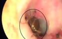 VIDEO | Αηδιαστικό: Κατσαρίδα ζούσε μέσα στο αυτί του!