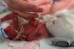 Πρόωρο μωρό σώθηκε εξαιτίας ενός ψαλιδιού!