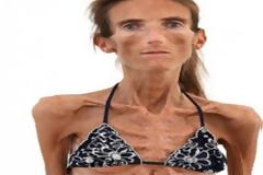 Σοκάρει η ιστορία της Valeria που ζυγίζει μόνο 25 κιλά! - Κι όμως έχει 20χρονες θαυμάστριες που θέλουν να της μοιάσουν!