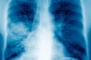 Τα αίτια και τα συμπτώματα της πνευμονίας - Φωτογραφία 1