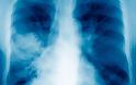 Τα αίτια και τα συμπτώματα της πνευμονίας
