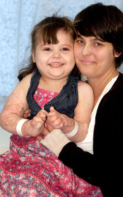 Μωράκι που έπεσε σε βραστό νερό είναι καλά μετά από 321 επεμβάσεις - Φωτογραφία 4