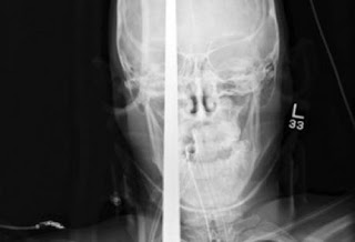 Σοκ στο Αγρίνιο: Μοναδικός στα χρονικά ο τραυματισμός- Η βέργα του ψαροντούφεκου του διαπέρασε το κρανίο - Φωτογραφία 1