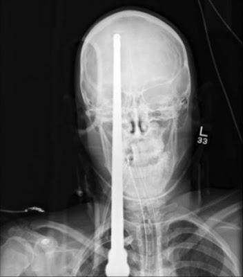 Σοκ στο Αγρίνιο: Μοναδικός στα χρονικά ο τραυματισμός- Η βέργα του ψαροντούφεκου του διαπέρασε το κρανίο - Φωτογραφία 2