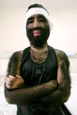 O πιο τριχωτός άνθρωπος στον κόσμο - Φωτογραφία 2