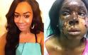 Λονδίνο: 20χρονη υπάλληλος της Victoria Secret's δέχτηκε επίθεση με οξύ στο πρόσωπο