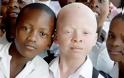 Τανζανία: Ακρωτηρίασαν αγόρι με αλμπινισμό, για να φτιάξουν απ’ το χέρι του… φυλαχτά