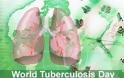 Ανακοίνωση από τη διεύθυνση δημόσιας υγείας της ΠΚΜ για την παγκόσμια ημέρα κατά της φυματίωσης