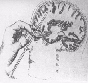 Λοβοτομή: μια παράλογη επέμβαση στον εγκέφαλο - Φωτογραφία 1