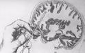 Λοβοτομή: μια παράλογη επέμβαση στον εγκέφαλο