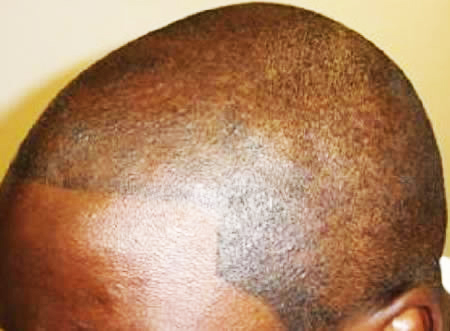 Φαλάκρα τέλος με ένα… τατουάζ μαλλιών! - Φωτογραφία 3