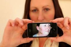 ΑΠΙΣΤΕΥΤΟ: Έπαθε αλλεργικό σοκ από... το iphone!