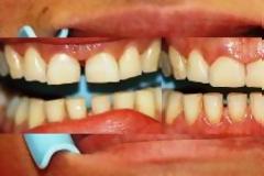 Γνωρίστε τις όψεις ρητίνης (bonding) και πως γίνονται με απόλυτη επιτυχία!