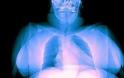 Οι παχύσαρκοι δέχονται περισσότερη ακτινοβολία στις ακτινογραφίες
