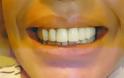 Αραιώνουν τα δόντια σας και παρουσιάζουν κινητικότητα; Μήπως είσαστε περιοδοντικός ασθενείς;