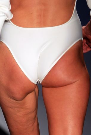 Σοκάρει η φωτογραφία του μοντέλου στην πασαρέλα - Kακή διατροφή και έλλειψη άσκησης, η αιτία του κακού! - Φωτογραφία 2