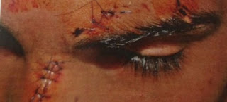 Eικόνες σοκ - Ρατσιστική επίθεση σε ανήλικο Αφγανό στην Αθήνα - Του χαράκωσαν το πρόσωπο - Φωτογραφία 1