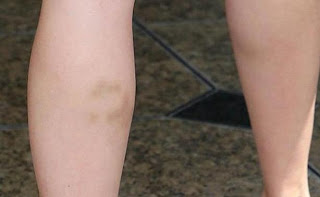 Πασίγνωστη ηθοποιός εμφανίστηκε με δαγκωματιά στο πόδι! - Φωτογραφία 1