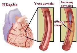 Σταθερή Στηθάγχη: Εργαστηριακή Διαγνωστική Προσέγγιση και Αντιμετώπιση - Φωτογραφία 2