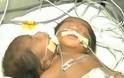 Ινδία: Γεννήθηκε μωρό με δύο κεφάλια