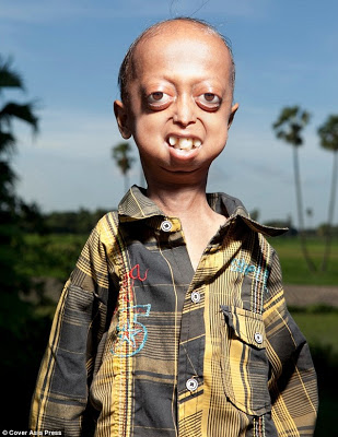 Ινδία: 14χρονος ζει στο σώμα ανθρώπου 110 ετών - Φωτογραφία 2