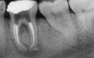 Επικίνδυνες οι συχνές ακτινογραφίες δοντιών - Φωτογραφία 1